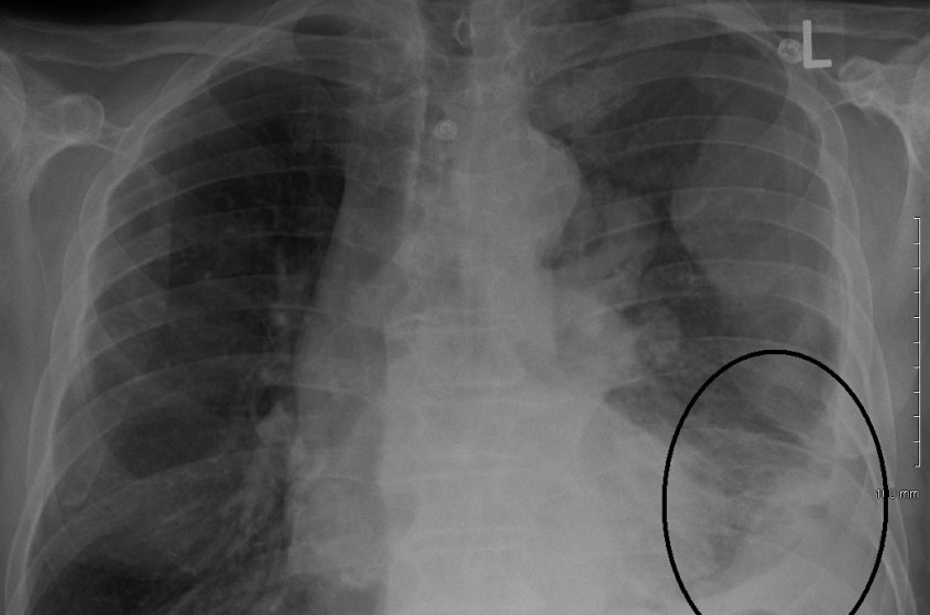 Abogado de Mesothelioma en Dallas Tejas